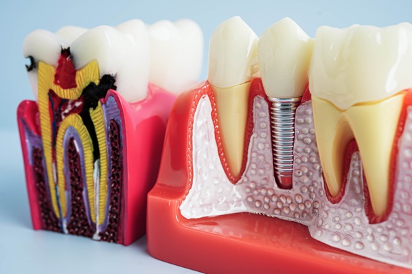 Dental Implant Crown Placement FAQs