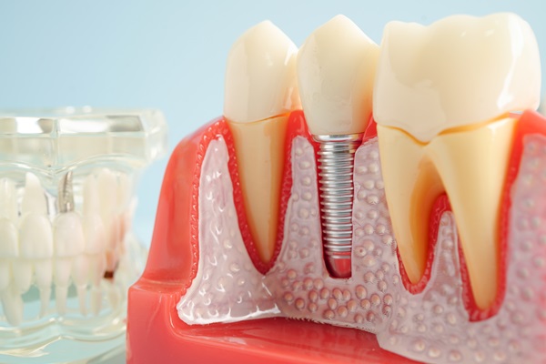 Single Tooth Replacement Options